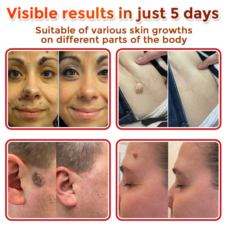 ClearPatch™ Microneedle Blemish Removal Patch — 50% OFF Today