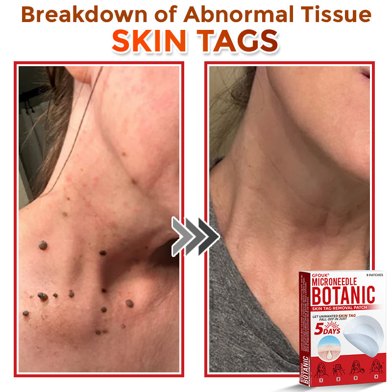 ClearPatch™ Microneedle Blemish Removal Patch — 50% OFF Today