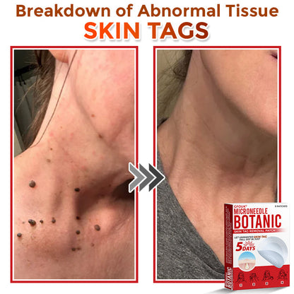 ClearPatch™ Microneedle Blemish Removal Patch — 50% OFF Today