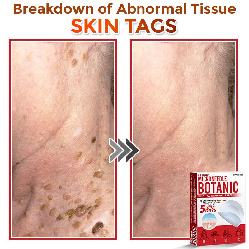 ClearPatch™ Microneedle Blemish Removal Patch — 50% OFF Today